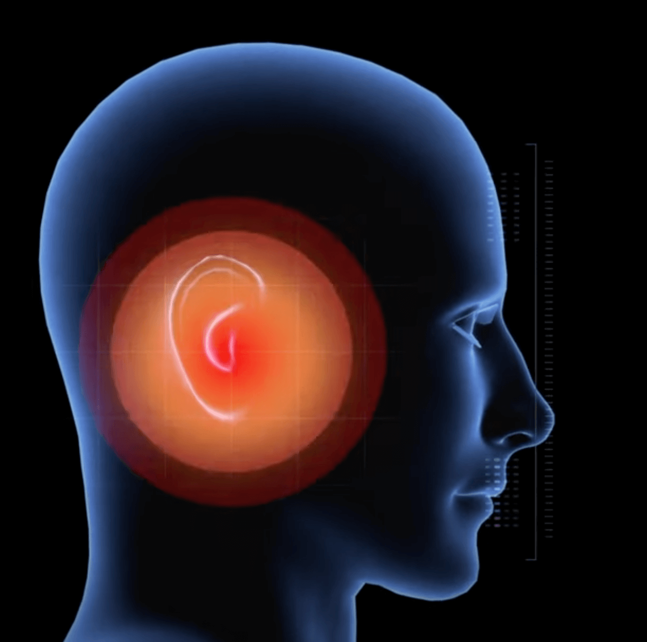 Complex Tinnitus Acoustic Treatment Programs